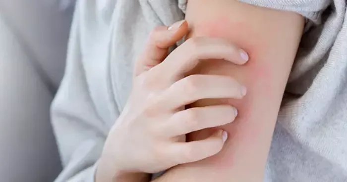 Uyuz tedavisi için kullanılan medikal bir krem, temiz havlular ve çamaşır makinesi